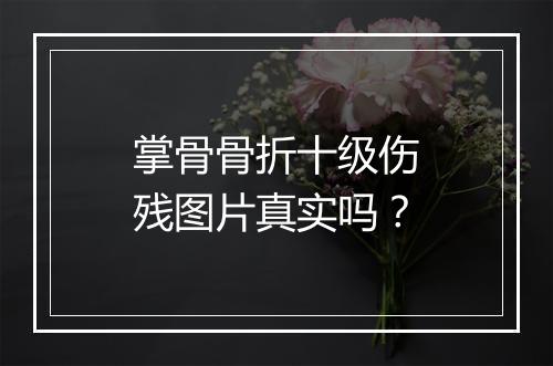 掌骨骨折十级伤残图片真实吗？