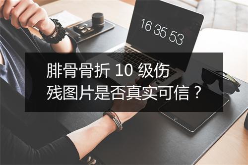 腓骨骨折 10 级伤残图片是否真实可信？