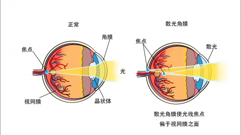 儿童散光矫正最佳年龄 散光形成的原因